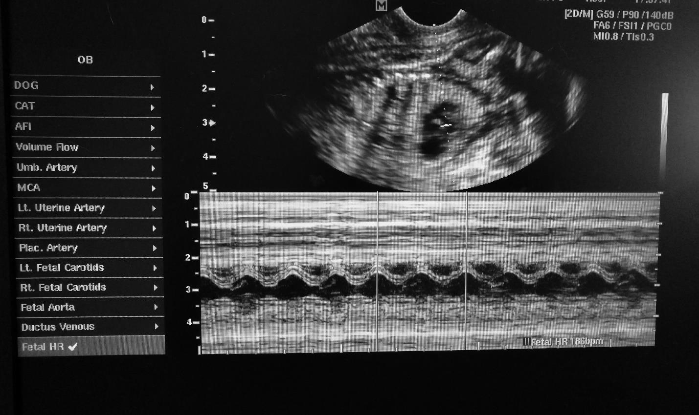 Ultrasound scan image showing fetal heart rate monitoring with waveform and anatomical view on screen